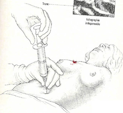 amnioparakentisi